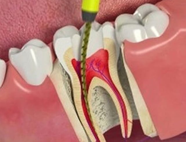 Root Canal Therapy in Peterborough