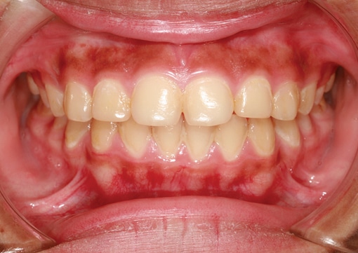 Gum Disease Therapy