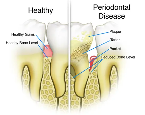 Periodontitis