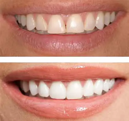 Before and After Teeth Shaping