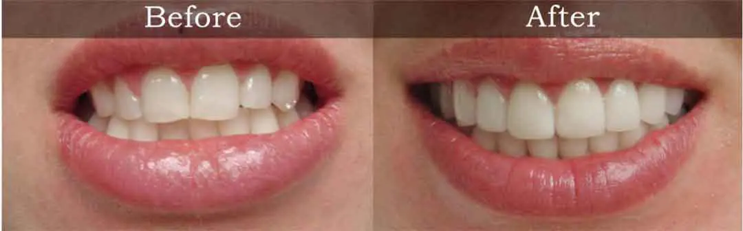 Teeth Shaping in Peterborough