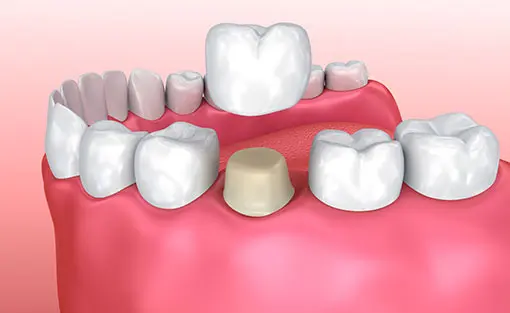 Dental Crowns in Peterborough