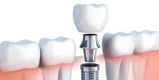 Dental Implant