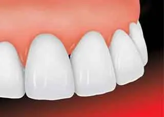 After Dental Veneers