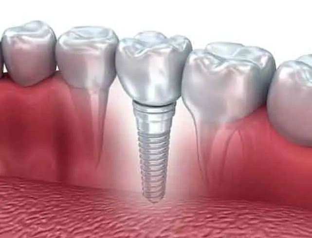 Dental Implants in Peterborough