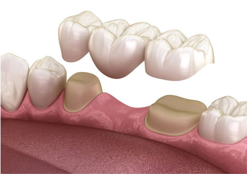 Dental Implants | Peterborough | Dr. Vipin Grover