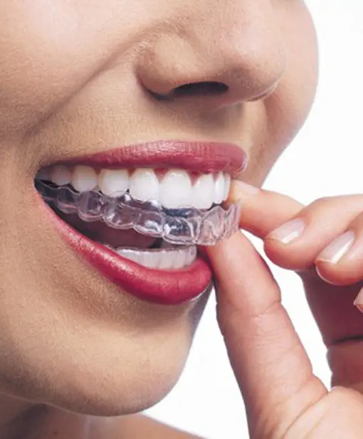 Invisalign Benefits